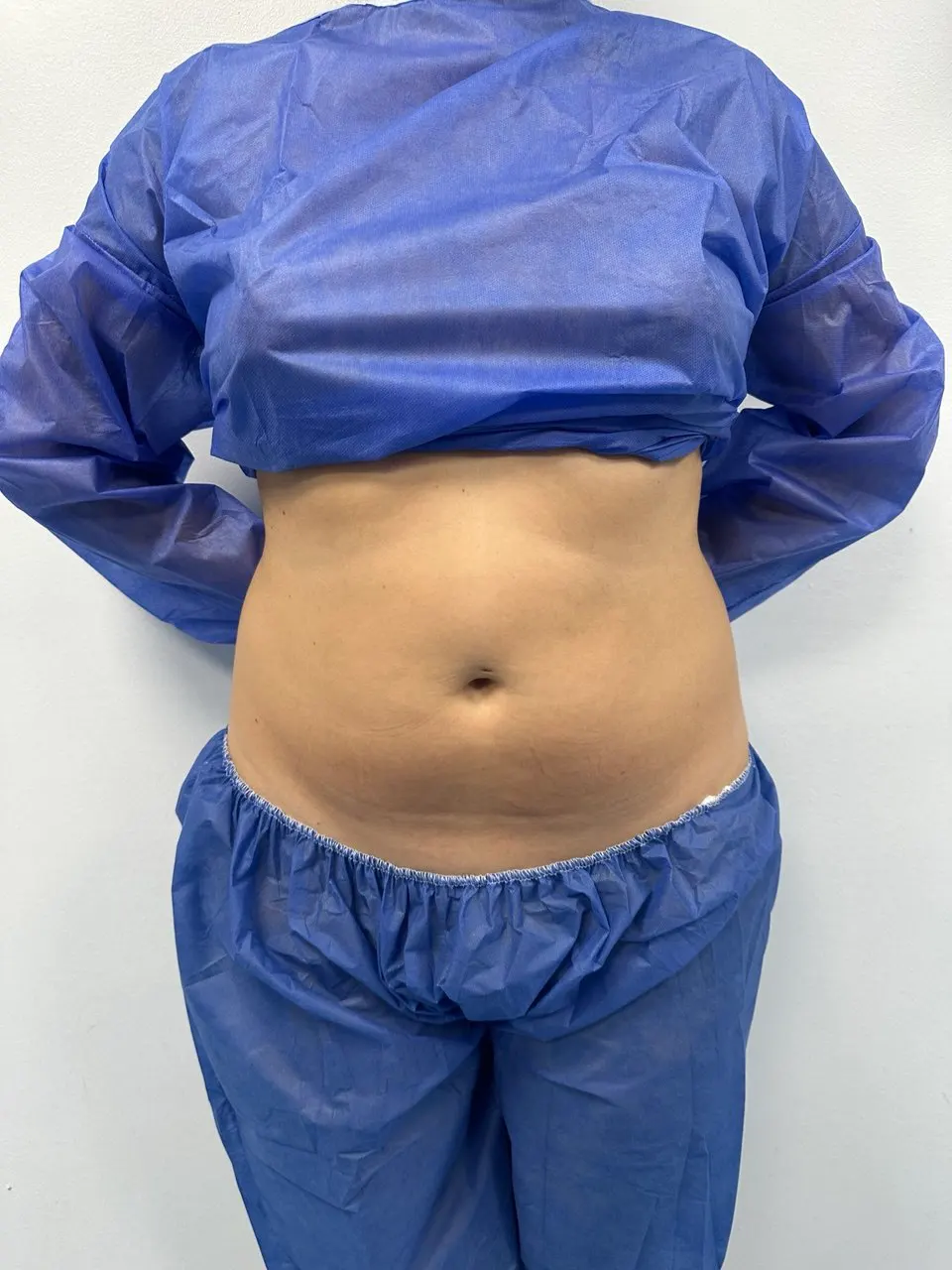  liposuction and BBI — before